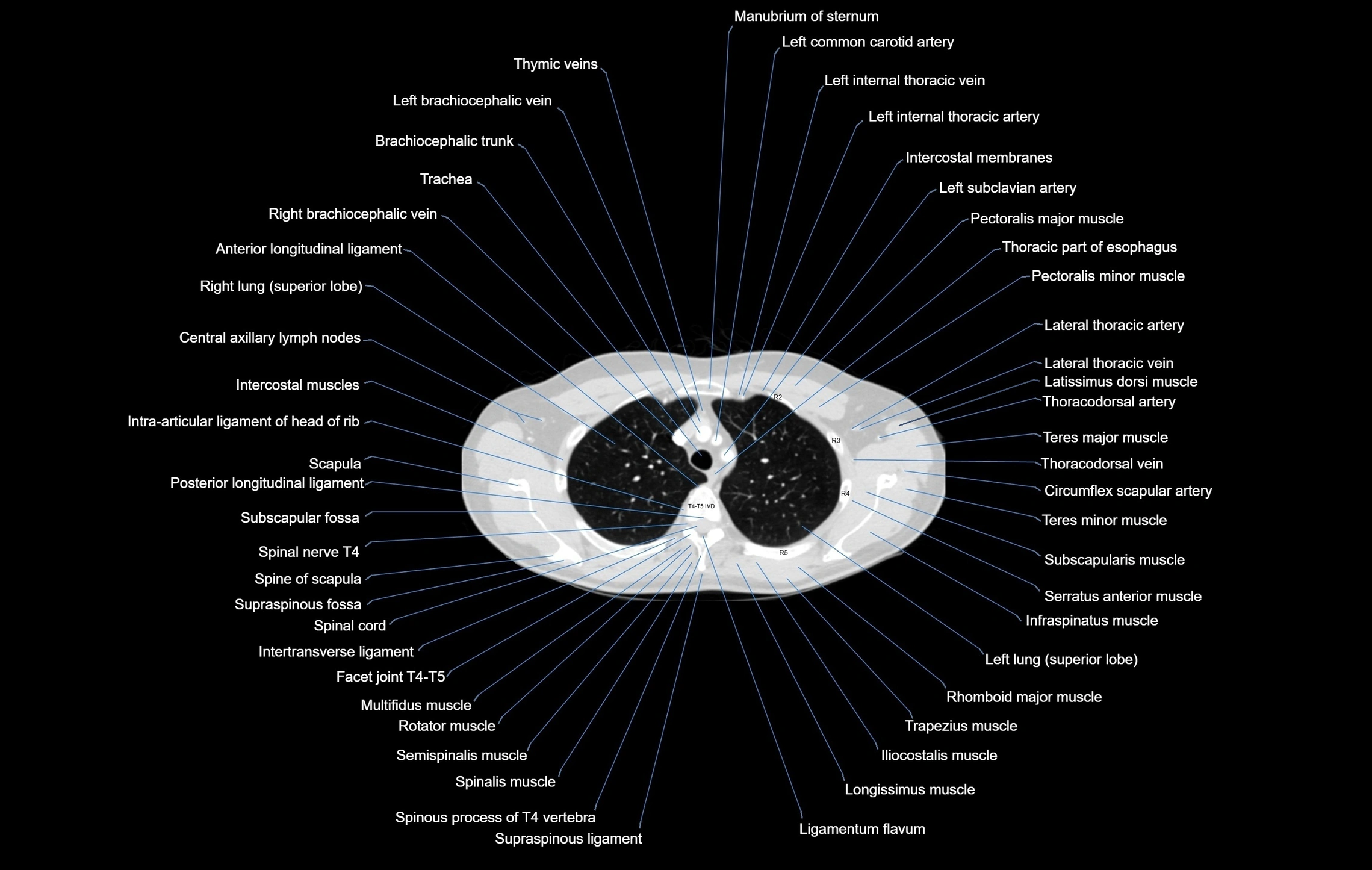 CT chest (thorax) labelled axial cross sectional anatomy radiology image-00029.webp